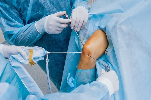 Knee Arthroscopy