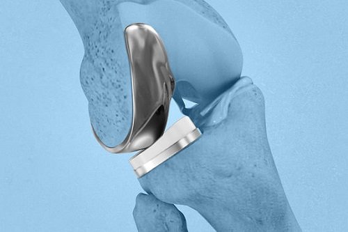 Partial Knee Replacement